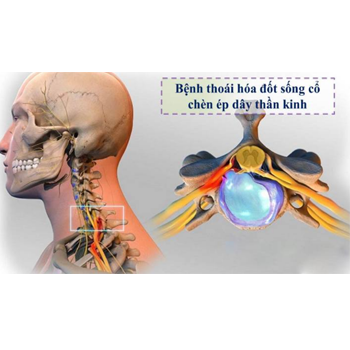 Chèn ép tủy sống vùng cổ